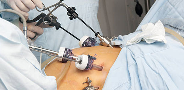 laparoscopic surgery