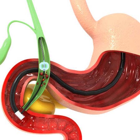 ercp